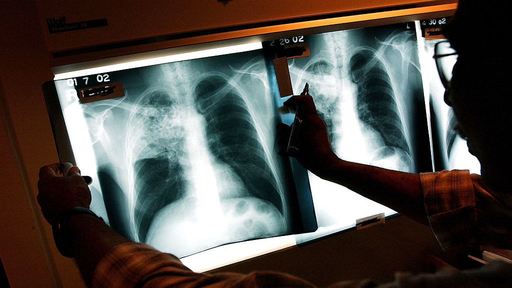 2 active tuberculosis cases traced to San Francisco strip club — KTVU FOX 2 Bay Area, Lafayette Health news